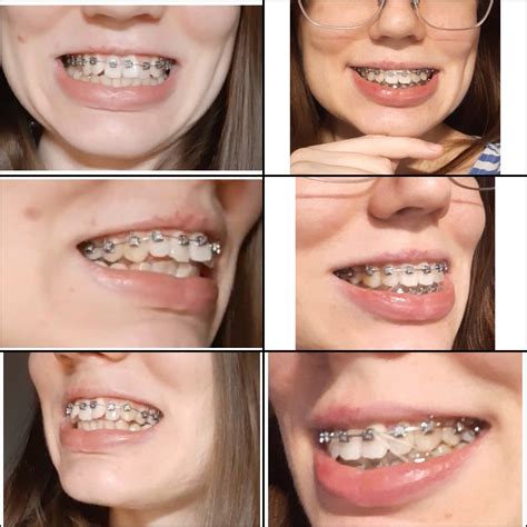 fastbraces reddit|Fast Braces Overbite in 4 months : r/braces .